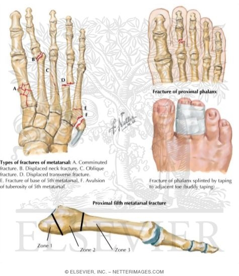 Watermarked preview of labeled image: Trauma of the Foot and Ankle
