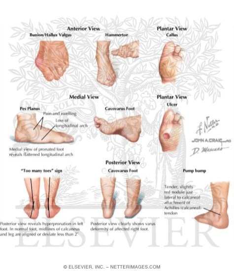 Watermarked preview of labeled image: Physical Examination of the Foot and Ankle