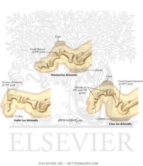 Watermarked preview of labeled image: Disorders of the Foot and Ankle