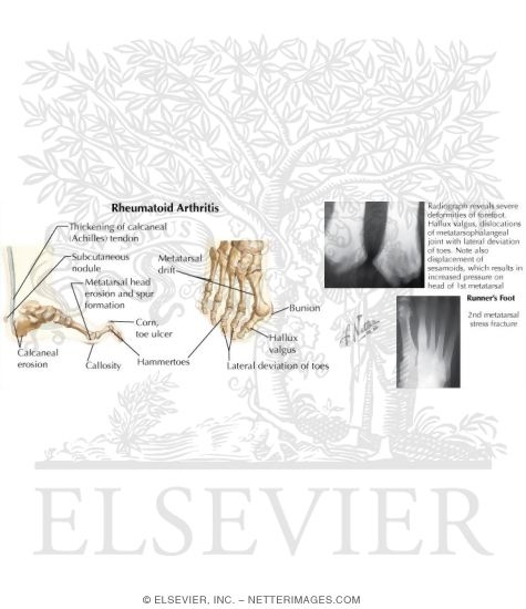 Watermarked preview of labeled image: Disorders of the Foot and Ankle