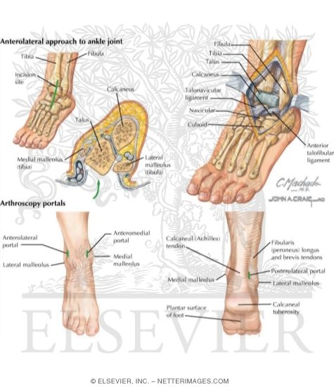 Watermarked preview of labeled image: Surgical Approaches to the Foot and Ankle