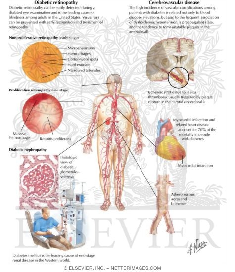 Diabetes Mellitus and Its Complications: Micro and Macrovascular Complications