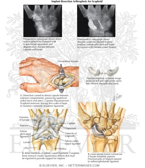 Implant Arthroplasty for Carpal Scaphoid Bone