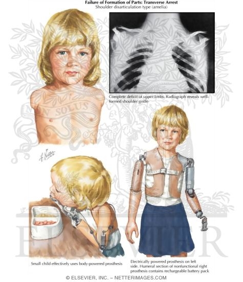 Failure of Formation of Parts: Transverse Arrest (Shoulder disarticulation type amelia)