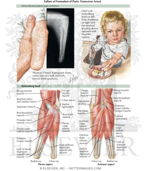 Failure of Formation of Parts: Transverse Arrest (Wrist disarticulation type acheiria) (Krukenberg Hand)