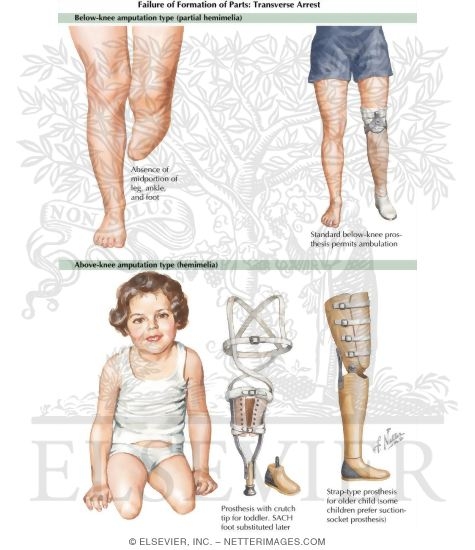 Watermarked preview of labeled image: Failure of Formation of Parts: Transverse Arrest (Below-knee amputation type partial hemimelia) (Above-knee amputation type hemimelia)
