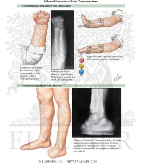 Failure of Formation of Parts: Transverse Arrest (Transmetacarpal amputation type aphalangia) (Transtarsal amputation type adactyly)