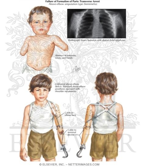 Failure of Formation of Parts: Transverse Arrest (Above-elbow amputation type hemimelia)