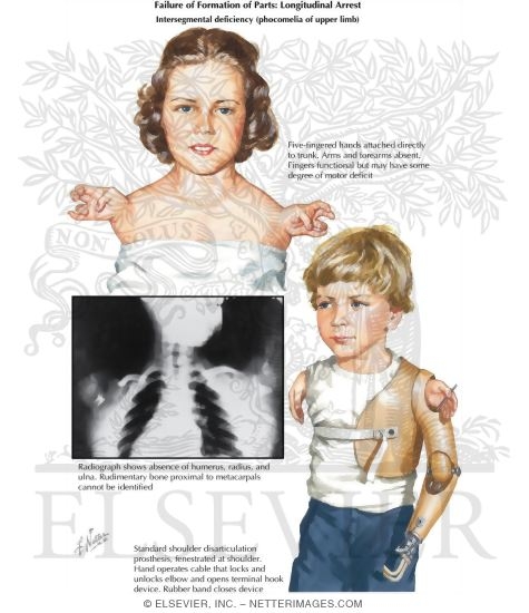 Failure of Formation of Parts: Longitudinal Arrest (Intersegmental deficiency phocomelia of upper limb)
