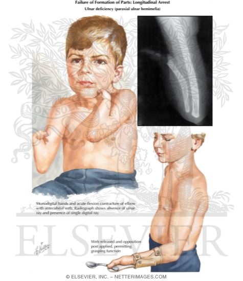 Watermarked preview of labeled image: Failure of Formation of Parts: Longitudinal Arrest (Ulnar deficiency paraxial ulnar hemimelia)