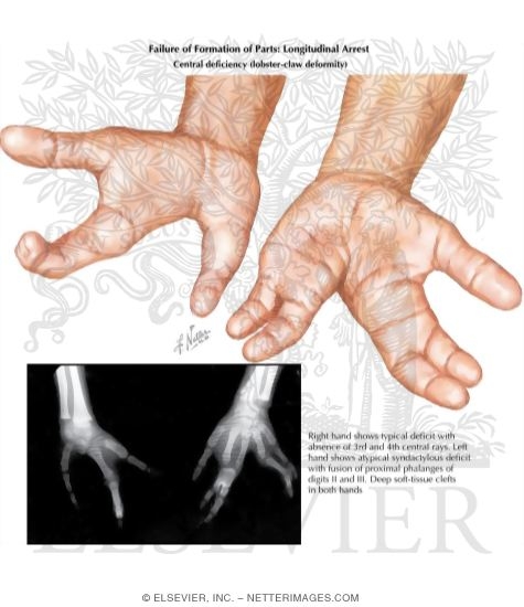 Failure of Formation of Parts: Longitudinal Arrest (Central deficiency lobster-claw deformity)