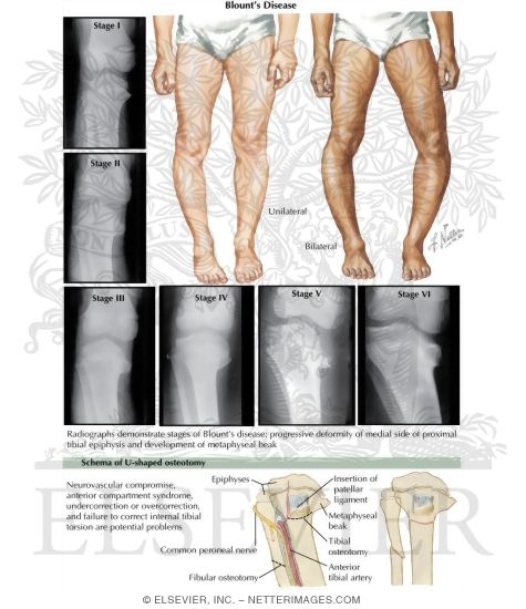 Blount's Disease
Infantile Tibia Vara