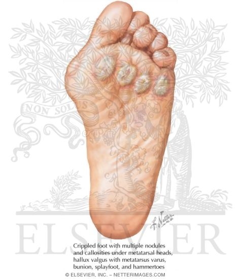Foot Involvement in Rheumatoid Arthritis