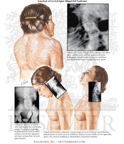Synostosis of Cervical Spine (Klippel-Feil Syndrome)