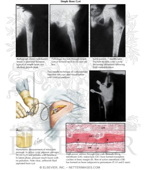 Watermarked preview of labeled image: Simple Bone Cyst