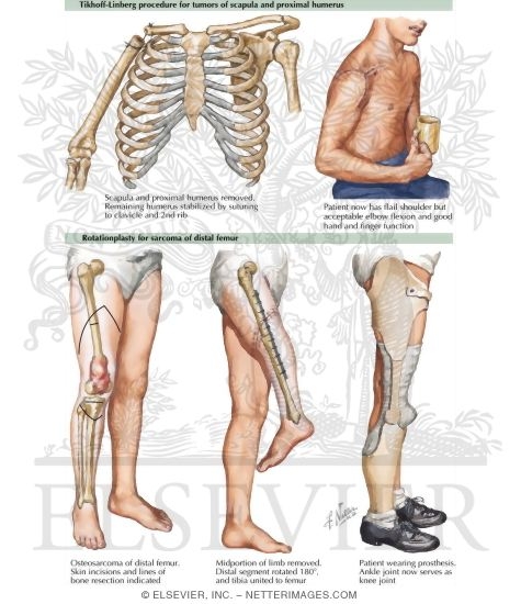 Tikhoff-Linberg Procedure for Tumors of Scapula and Proximal Humerus, Rotationplasty for Sarcoma of Distal Femur