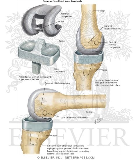 Posterior Stabilized Knee Prosthesis