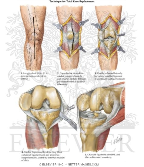 Technique for Total Knee Replacement