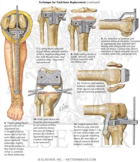 What happens in a total knee arthroplasty procedure?