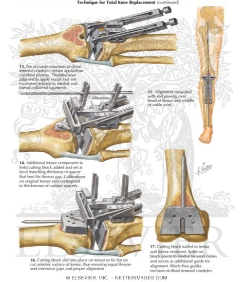 Watermarked preview of labeled image: Technique for Total Knee Replacement