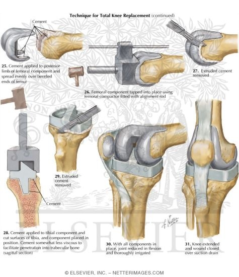 Total Knee Arthroplasty
Technique for Total Knee Replacement