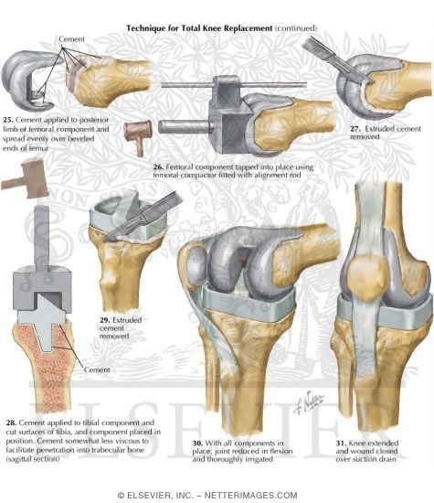 What happens in a total knee arthroplasty procedure?