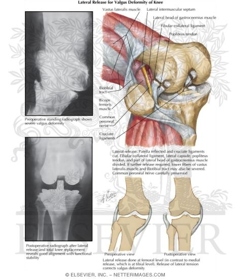 Watermarked preview of labeled image: Lateral Release for Valgus Deformity of Knee