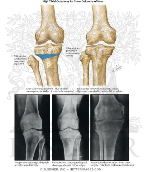 High Tibial Osteotomy for Varus Deformity of Knee
