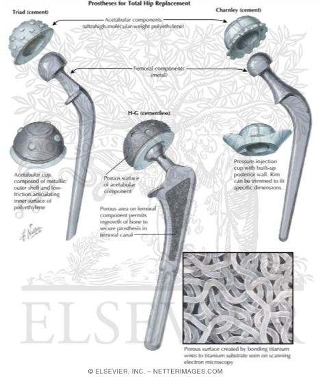 Watermarked preview of labeled image: Prostheses for Total Hip Replacement