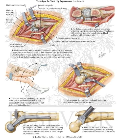Watermarked preview of labeled image: Technique for Total Hip Replacement