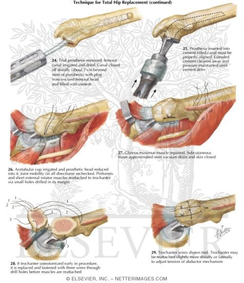 Watermarked preview of labeled image: Technique for Total Hip Replacement