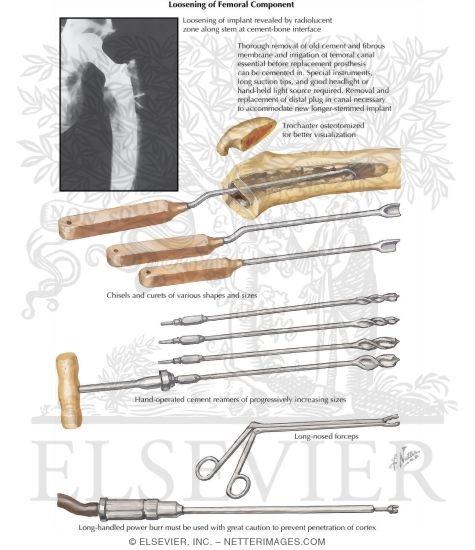 Loosening of Femoral Component