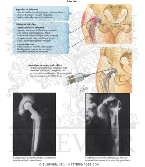 Total Hip Replacement: Infection