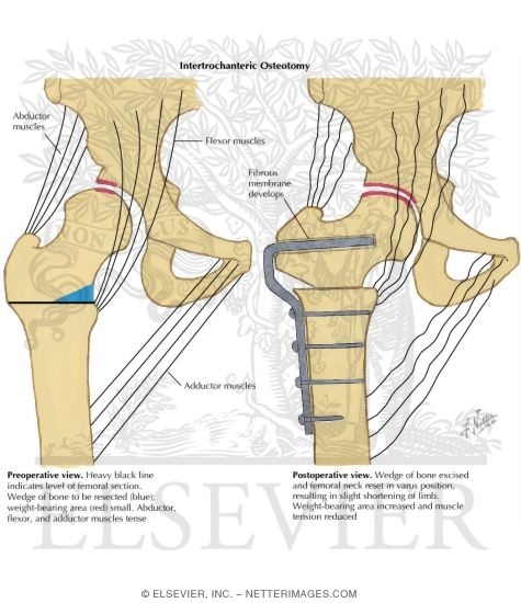 Intertrochanteric Osteotomy