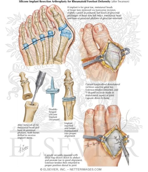 Watermarked preview of labeled image: Silicone Implant Resection Arthroplasty for Rheumatoid Forefoot