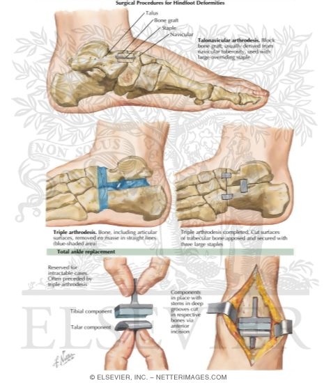 Watermarked preview of labeled image: Surgical Procedures for Hindfoot Deformities