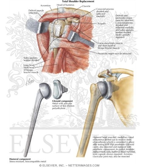 Total Shoulder Replacement