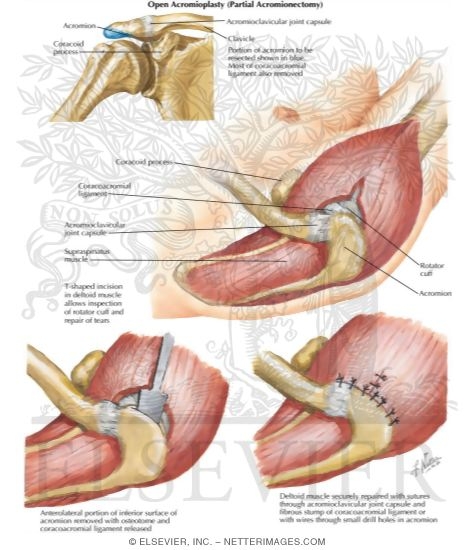 Watermarked preview of labeled image: Open Acromioplasty (Partial Acromionectomy)