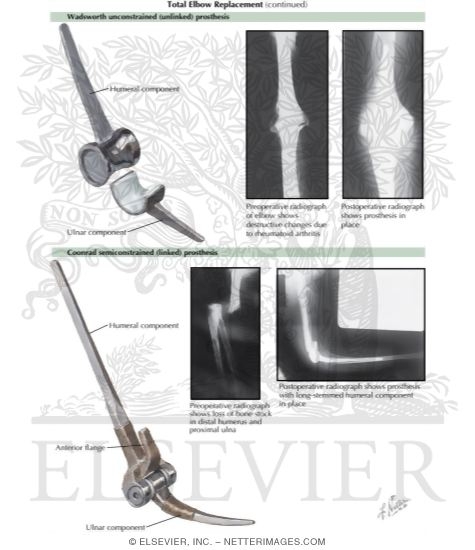 Total Elbow Replacement