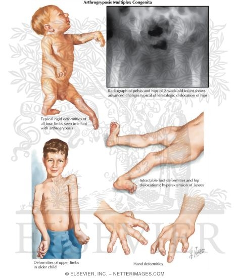 Arthrogryposis Multiplex Congenita