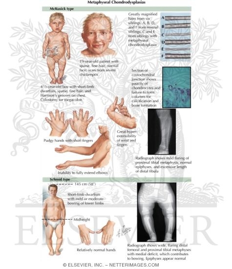 Watermarked preview of labeled image: Metaphyseal Chondrodysplasias