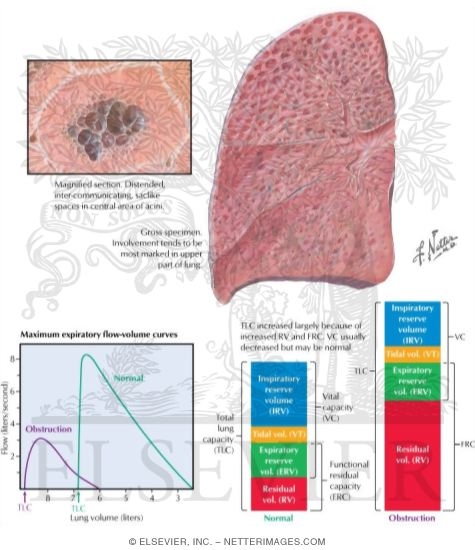 Centriacinar (Centrilobular) Emphysema