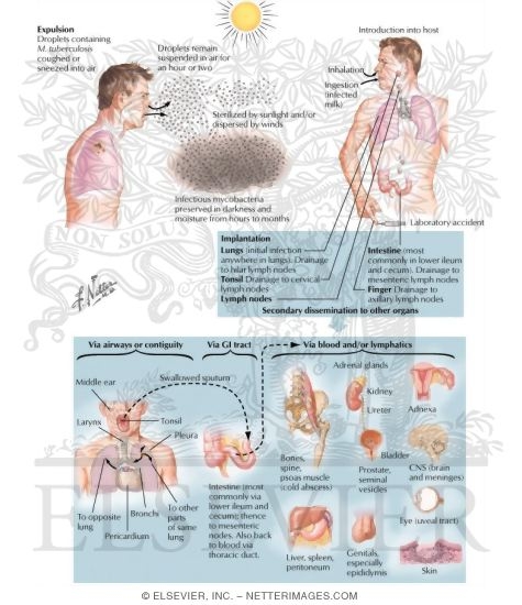 Dissemination of Tuberculosis