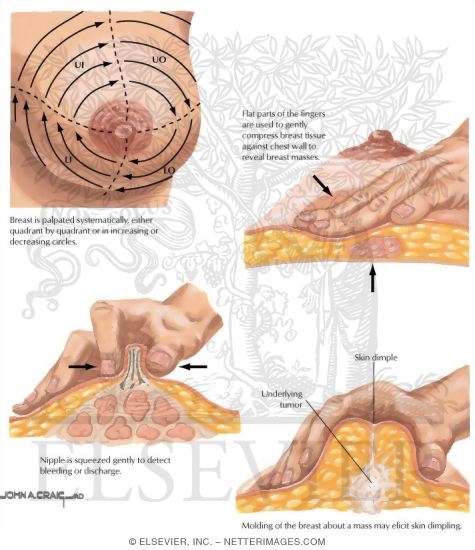 Watermarked preview of labeled image: Palpation of the Breasts 