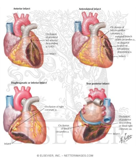 Localization of Myocardial Infarcts