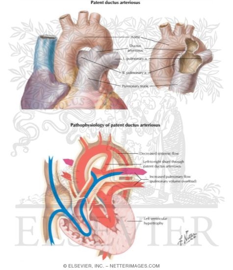 Watermarked preview of labeled image: Patent Ductus Arteriosus