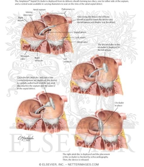 Watermarked preview of labeled image: Amplatzer Septal Occluder