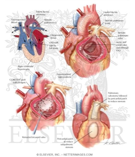 Watermarked preview of labeled image: Tetralogy of Fallot