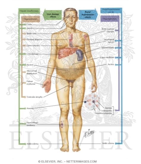 Watermarked preview of labeled image: Cirrhosis III - Clinical Manifestations