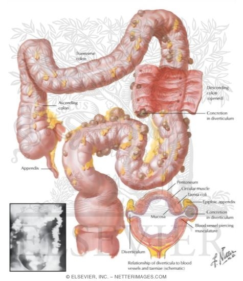 Watermarked preview of labeled image: Diverticulosis   